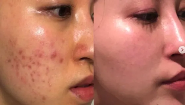 Bella's before and after carnivore diet skin photo