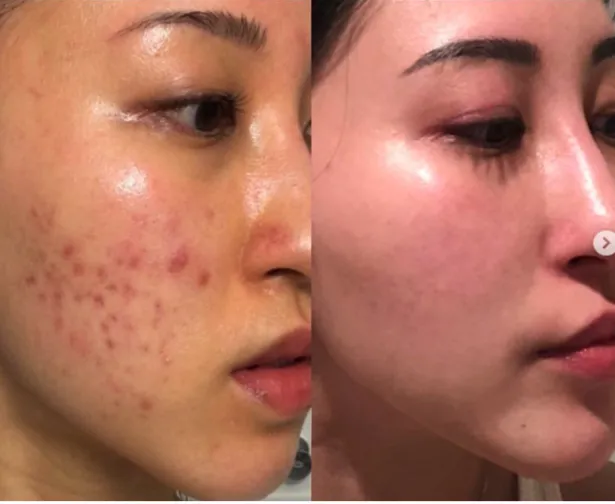 Before and after photo of carnivore diet healing skin eczema