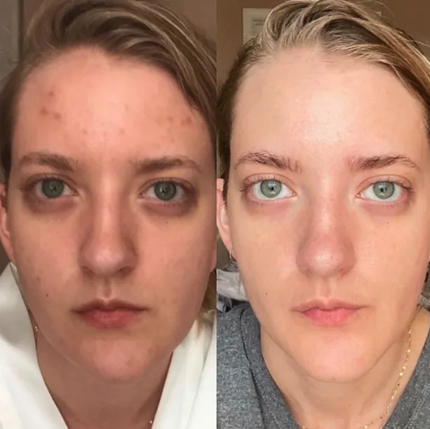 Jacie's before and after carnivore diet skin photo