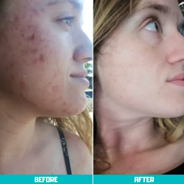 Joane's before and after carnivore diet skin photo