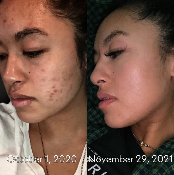 Lia's before and after carnivore diet photo